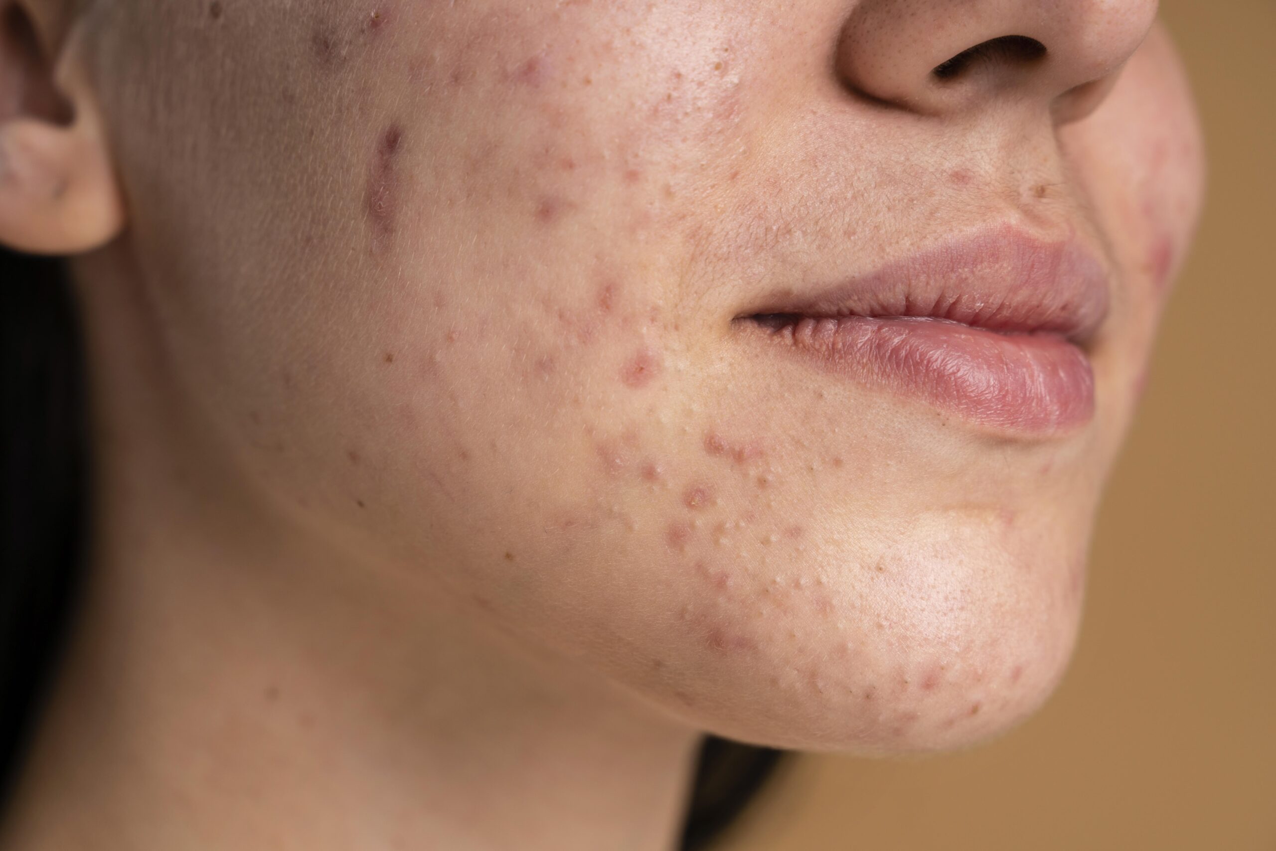 Pigmentation and Dark Spot Removal