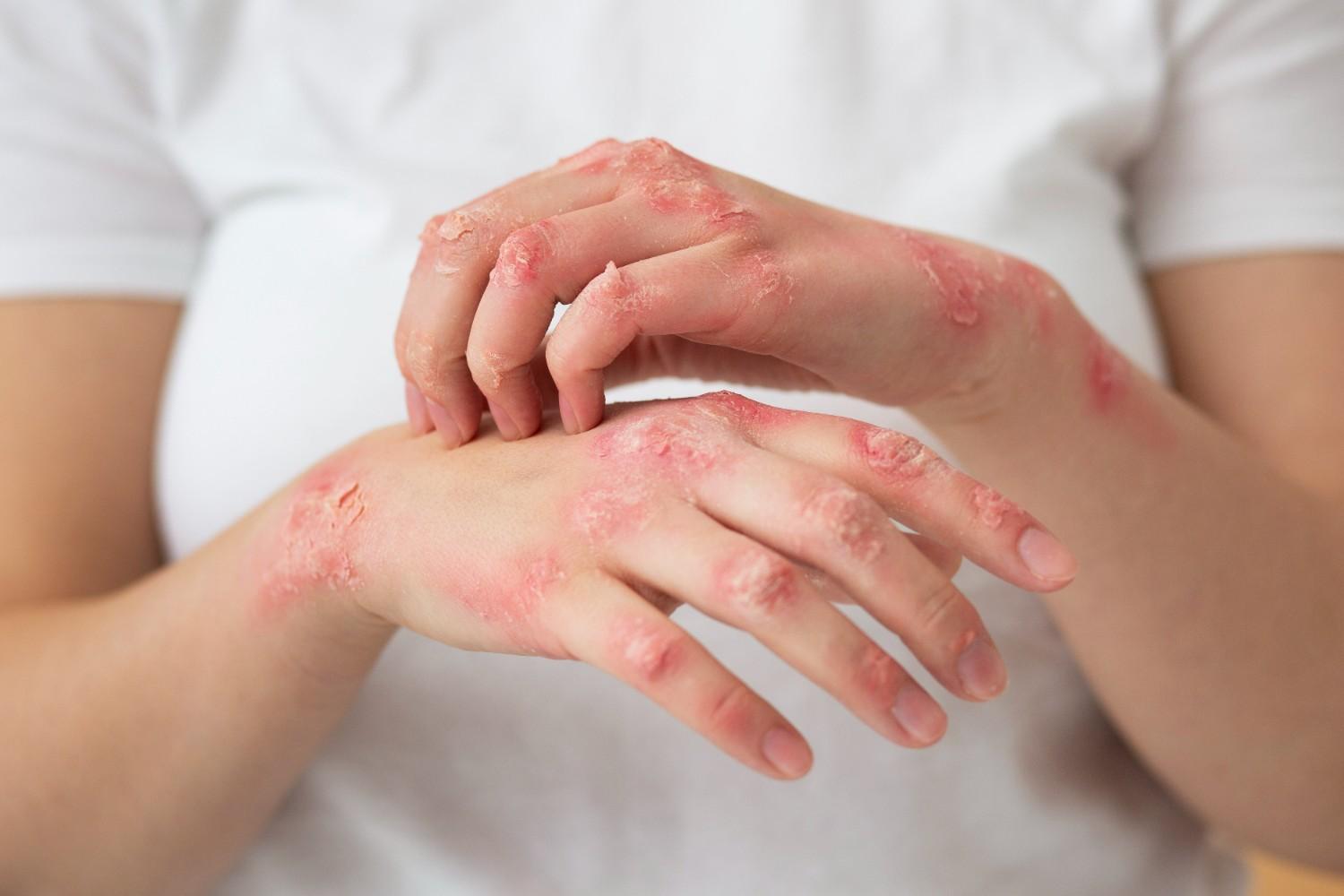 Psoriasis and Eczema Management