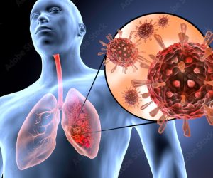 Pulmonary infections & Pneumonia