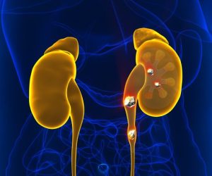 kidney-stones-removal-without-surgery-in-haryana